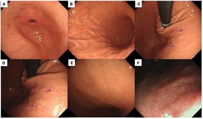 Unveiling early stage autoimmune gastritis: novel endoscopic insights from two case reports